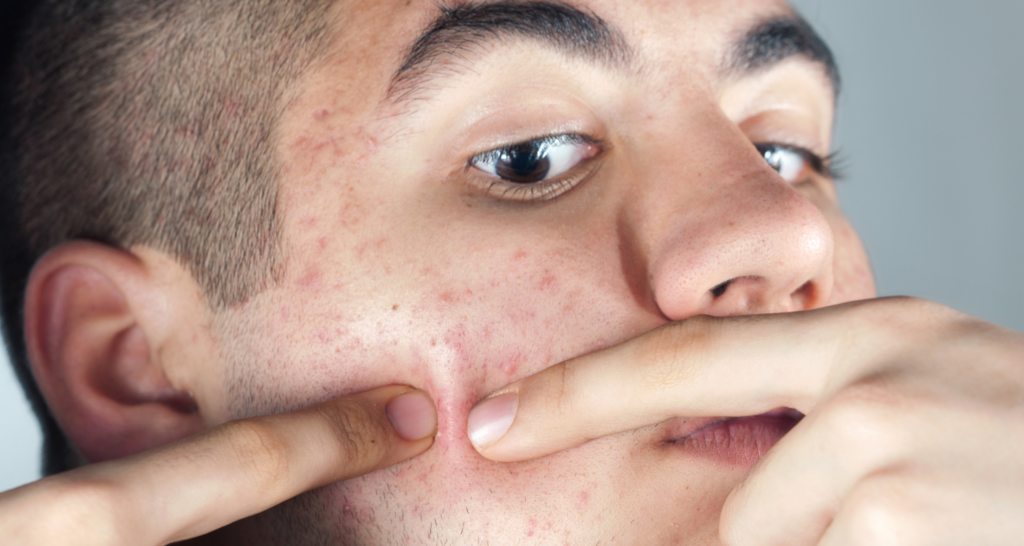 Penyebab Jerawat: Kenali Gejala dan Cara Penanganannya