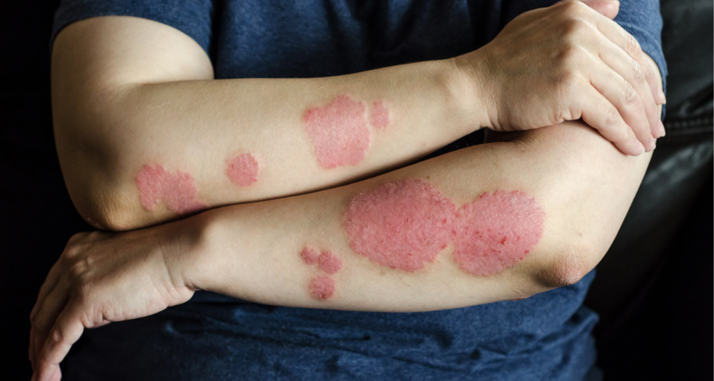 Pencegahan Psoriasis: Kenali Gejala dan Cara Mengatasinya