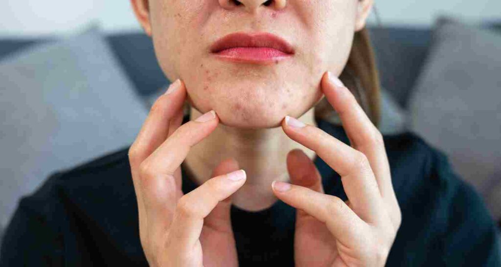 Jerawat Menstruasi: Kenapa Muncul Saat Haid?