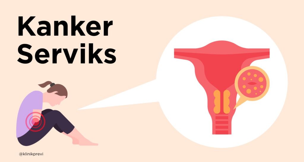 kanker-serviks